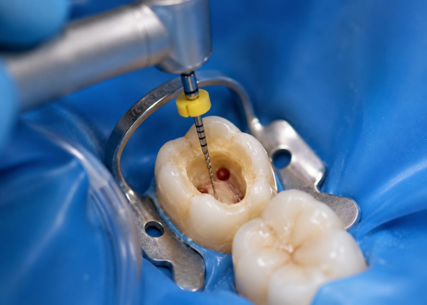 Endodoncia